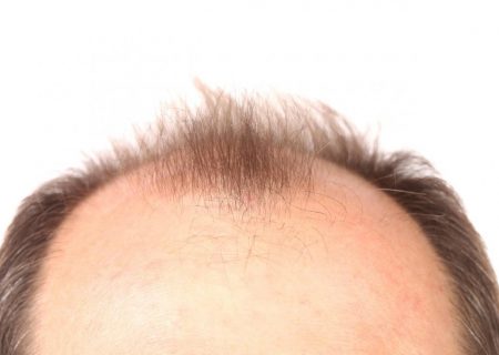 جدیدترین روش درمان طاسی سر با کاشت مو