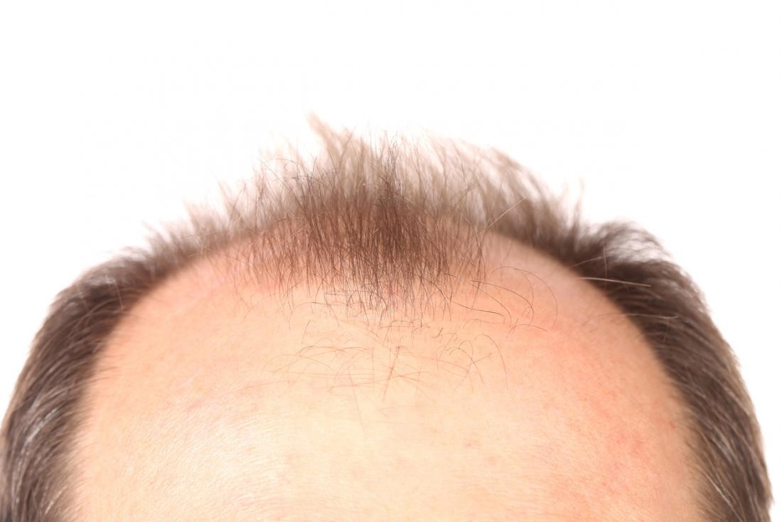 جدیدترین روش درمان طاسی سر با کاشت مو