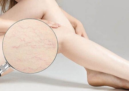 معرفی روشهای درمانی برای خلاص شدن از رگ های عنکبوتی