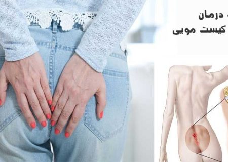 بیماری کیست مویی و به صرفه ترین روش درمان