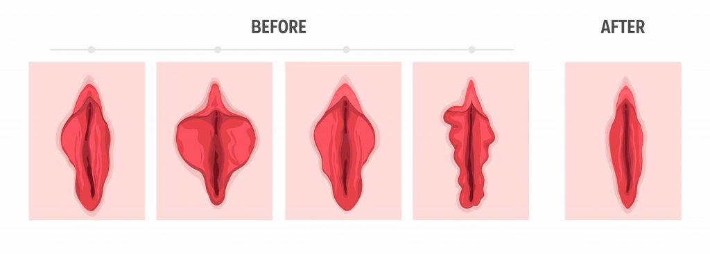 گشادی واژن، دلیل اصلی انجام جراحی زیبایی واژن