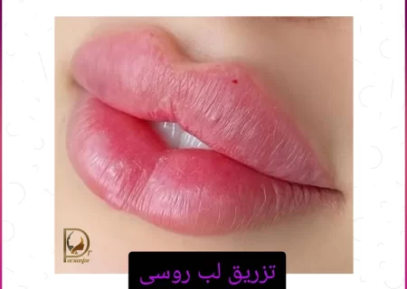 تزریق ژل لب روسی و همه چیز درباره آن