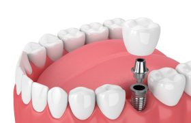 ایمپلنت دندان جایگزینی برای دندانها