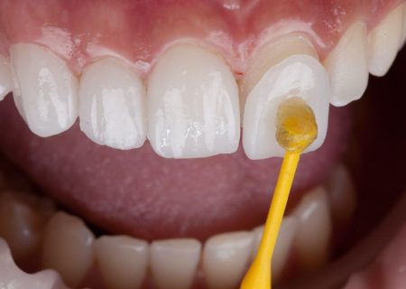 خدمات پزشکی لمینت دندان در دکترتو کلینیک + لیست بهترین ارائه دهندگان