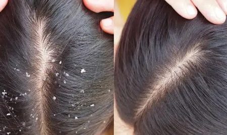اگر به دنبال رهایی از شوره های سر هستید، استفاده از این شامپوها پیشنهاد می شود!
