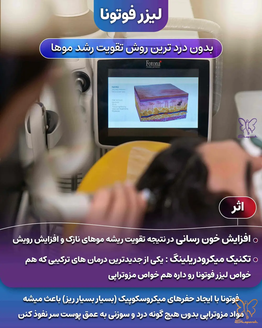 لیزر فوتونا برای مو سر در شاپرک طلایی مشهد