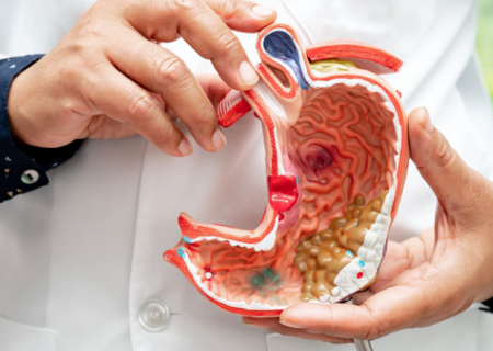 خطرات عوارض بوتاکس معده در سنین میانسالی